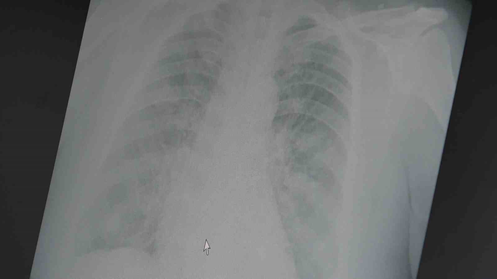 Profesör uyardı: "Grip aşılarının etkinliği bu sezon düşük"