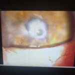 25 yıllık görme kaybı son buldu: Bu ameliyat Kastamonu’da ilk kez gerçekleştirildi