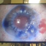 25 yıllık görme kaybı son buldu: Bu ameliyat Kastamonu’da ilk kez gerçekleştirildi