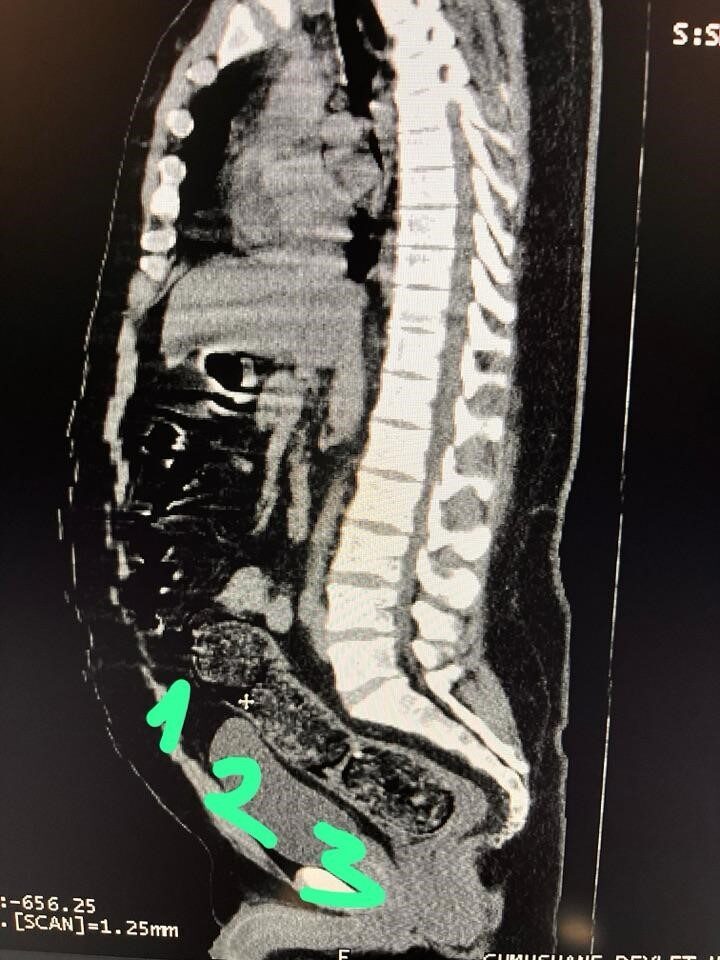 Bağırsaklarında 3 adet uyuşturucu dolu kapsül çıkan İranlı şahıs tutuklandı