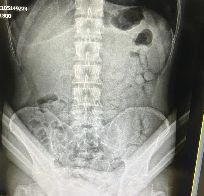 Bağırsaklarında 55 adet uyuşturucu dolu kapsül çıkan İranlı şahıs tutuklandı