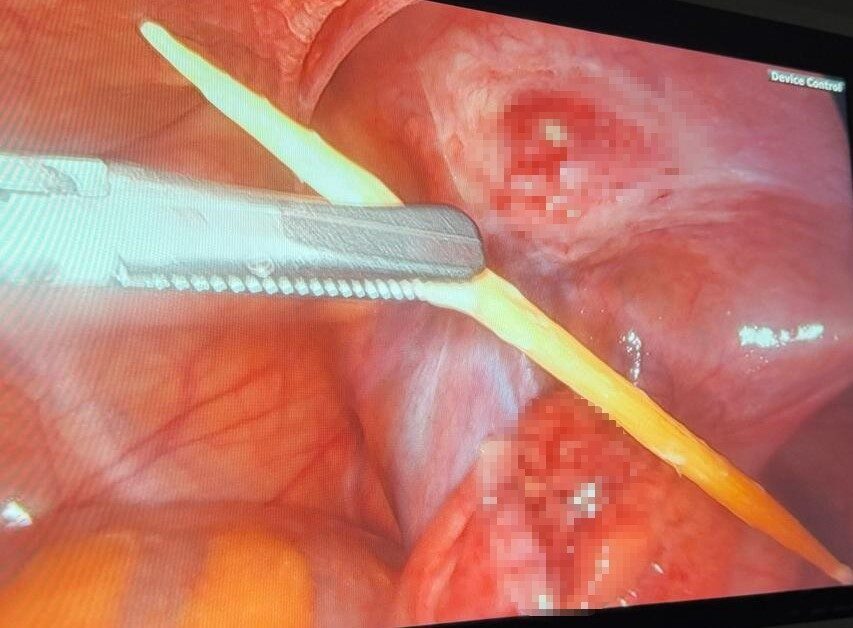 Sinop’ta 17 yaşındaki bir hastanın kalın bağırsağını delen kürdan kapalı yöntemle çıkarıldı