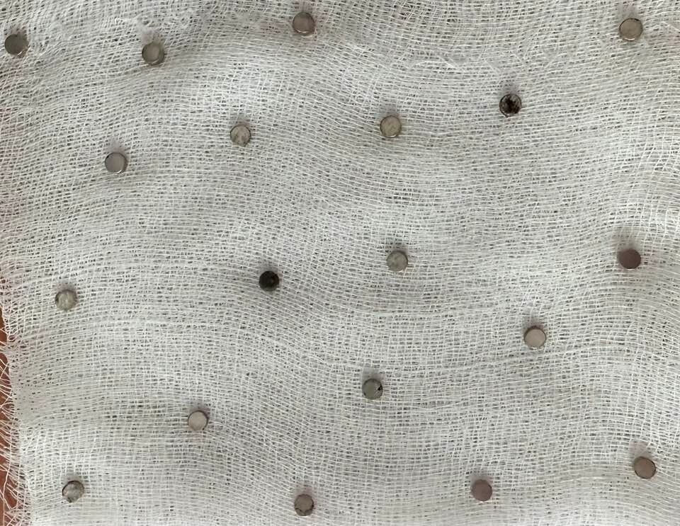 Çocuğun boğazından 19 adet mıknatıs çıkartıldı