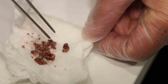 Elazığ’da estetik ameliyatta şaşırtan olay, burundan taş çıktı