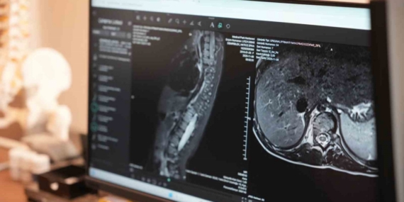 Sinsi ilerleyen bu rahatsızlığı ilk fark eden anneler oluyor