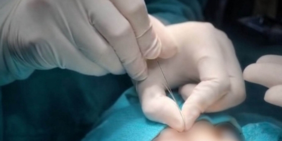 Çukurca’da gözyaşı kanalı ameliyatları yapılmaya başlandı