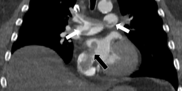 Tekden’de başarılı çalışmalara imza atan radyoloji uzmanından hayati tespit